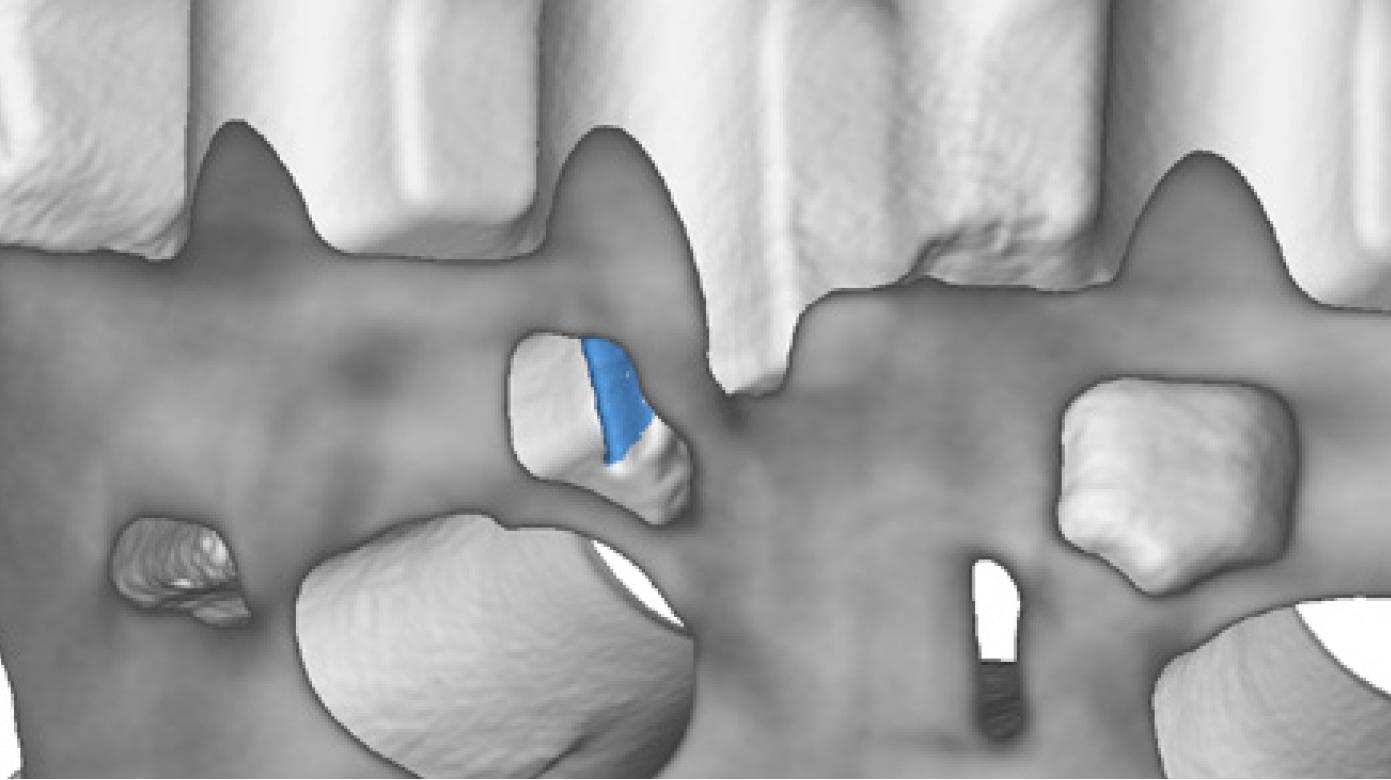 ZEISS light metal broken core