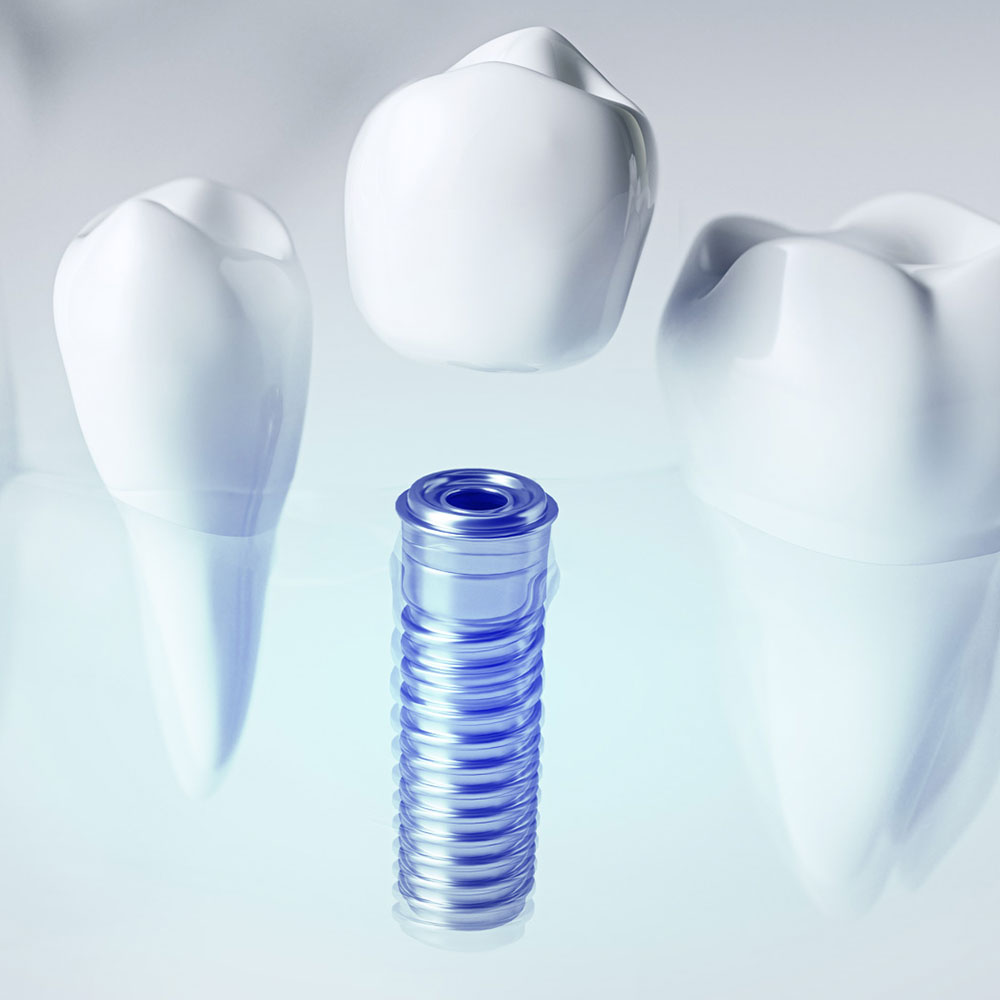 Dental implants
