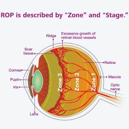 Retinopathy of Prematurity (ROP)