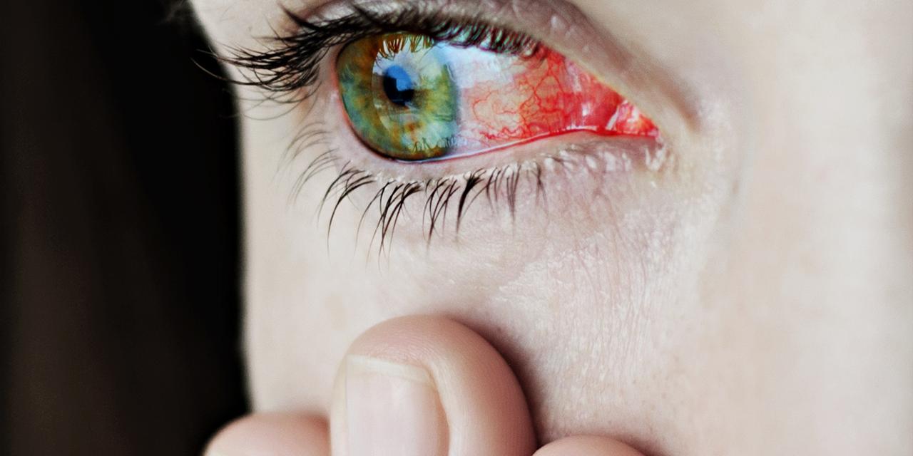 Closeup of irritated or infected red bloodshot eyes - uveitis